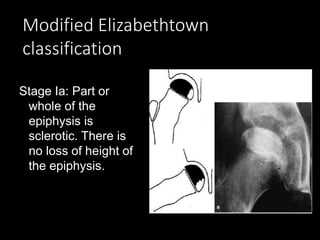 Modified Elizabethtown
classification
Stage Ia: Part or
whole of the
epiphysis is
sclerotic. There is
no loss of height of
the epiphysis.
 