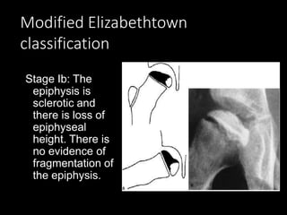 Modified Elizabethtown
classification
Stage Ib: The
epiphysis is
sclerotic and
there is loss of
epiphyseal
height. There is
no evidence of
fragmentation of
the epiphysis.
 
