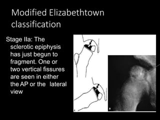 Modified Elizabethtown
classification
Stage IIa: The
sclerotic epiphysis
has just begun to
fragment. One or
two vertical fissures
are seen in either
the AP or the lateral
view
 