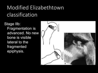 Modified Elizabethtown
classification
Stage IIb:
Fragmentation is
advanced. No new
bone is visible
lateral to the
fragmented
epiphysis.
 