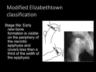 Modified Elizabethtown
classification
Stage IIIa: Early
new bone
formation is visible
on the periphery of
the necrotic
epiphysis and
covers less than a
third of the width of
the epiphysis
 