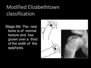 Modified Elizabethtown
classification
Stage IIIb: The new
bone is of normal
texture and has
grown over a third
of the width of the
epiphysis.
 