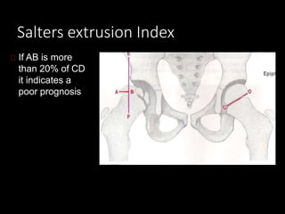Salters extrusion Index
If AB is more
than 20% of CD
it indicates a
poor prognosis
 