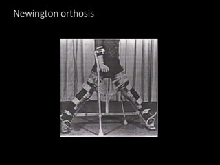 Newington orthosis
 