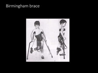 Birmingham brace
 