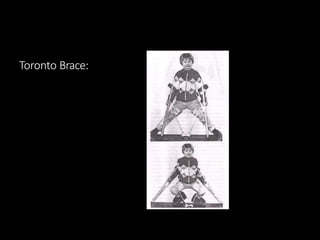 Toronto Brace:
 