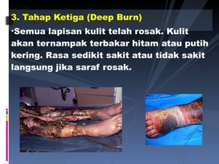 3. Tahap Ketiga (Deep Burn) Semua lapisan kulit telah rosak. Kulit akan ternampak terbakar hitam atau putih kering. Rasa sedikit sakit atau tidak sakit langsung jika saraf rosak. 