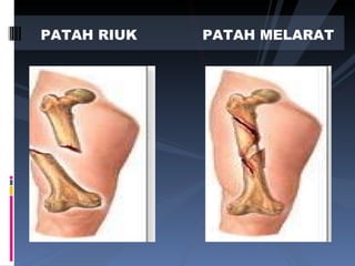 PATAH RIUK PATAH MELARAT 