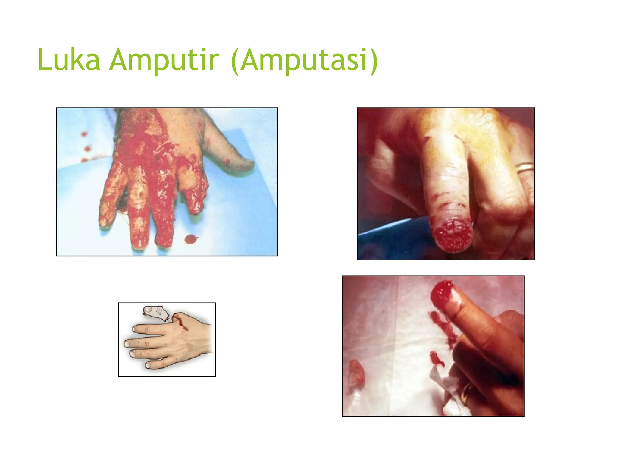 Luka Amputir (Amputasi)
 