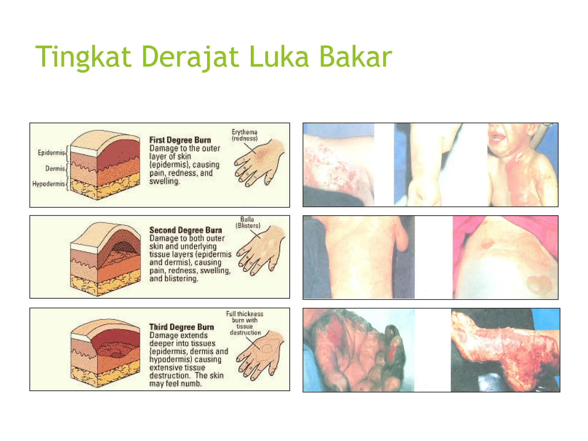 Tingkat Derajat Luka Bakar
 