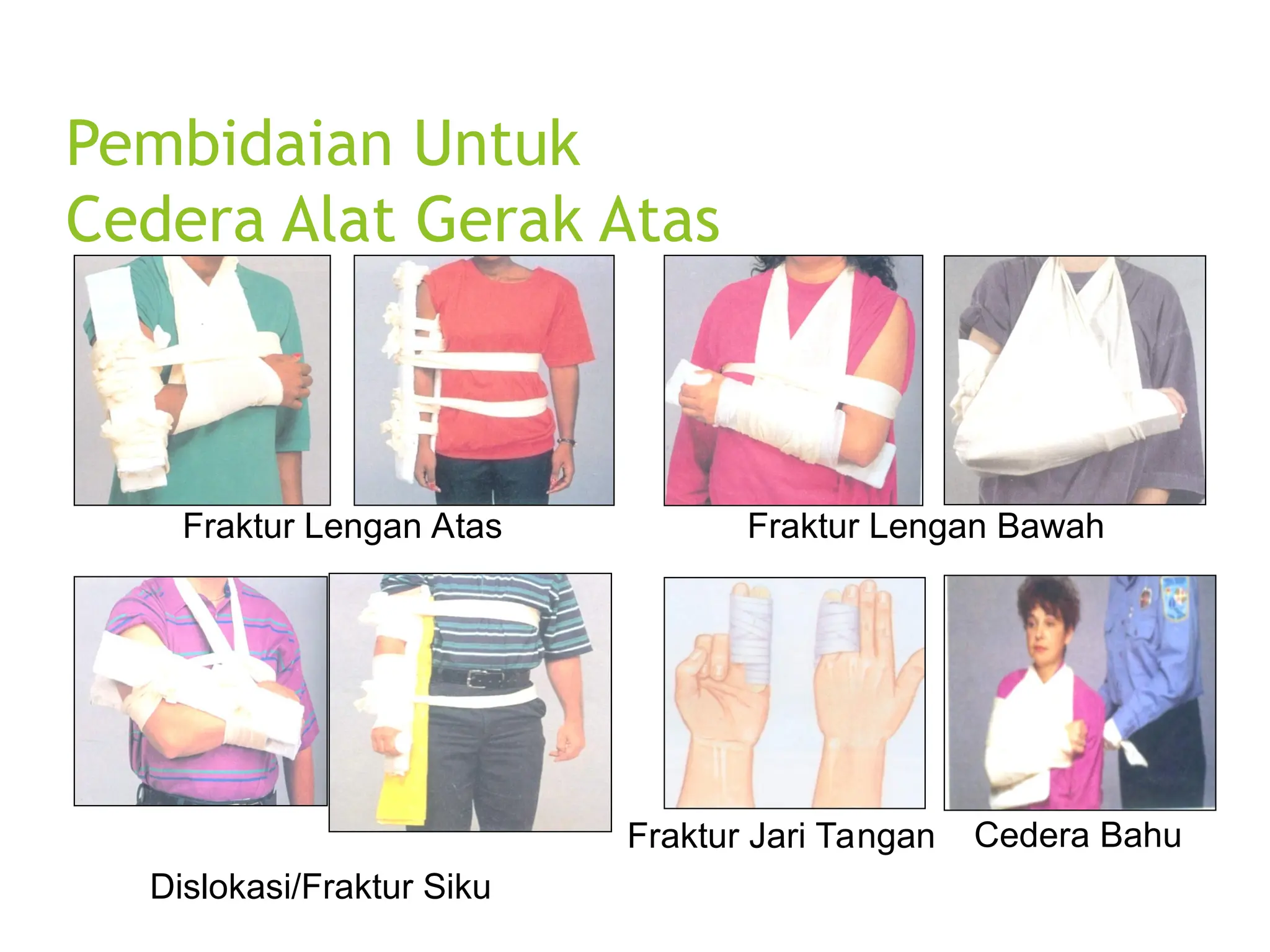 Pembidaian Untuk
Cedera Alat Gerak Atas
Fraktur Lengan Atas
Dislokasi/Fraktur Siku
Fraktur Lengan Bawah
Fraktur Jari Tangan Cedera Bahu
 
