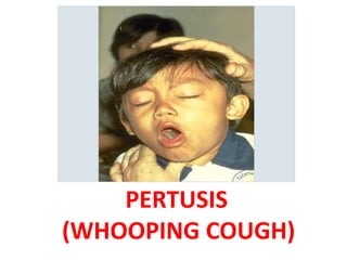 PERTUSIS
(WHOOPING COUGH)
 