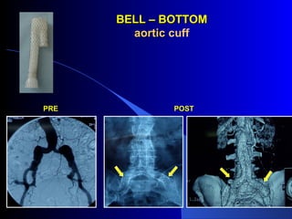 PRE POST
BELL – BOTTOMBELL – BOTTOM
aorticaortic cuff
 