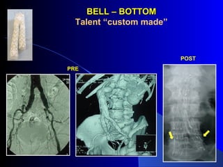 PRE
POST
BELL – BOTTOMBELL – BOTTOM
Talent “custom made”
 
