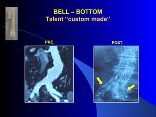 BELL – BOTTOM
Talent “custom made”
PRE POST
 