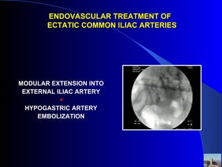 ENDOVASCULAR TREATMENT OFENDOVASCULAR TREATMENT OF
ECTATIC COMMON ILIAC ARTERIESECTATIC COMMON ILIAC ARTERIES
MODULAR EXTENSION INTO
EXTERNAL ILIAC ARTERY
+
HYPOGASTRIC ARTERY
EMBOLIZATION
 