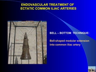 ENDOVASCULAR TREATMENT OFENDOVASCULAR TREATMENT OF
ECTATIC COMMON ILIAC ARTERIESECTATIC COMMON ILIAC ARTERIES
BELL – BOTTOM TECHNIQUE:
Bell-shaped modular extension
into common iliac artery
 