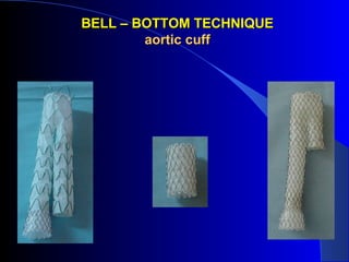 BELL – BOTTOM TECHNIQUEBELL – BOTTOM TECHNIQUE
aortic cuffaortic cuff
 