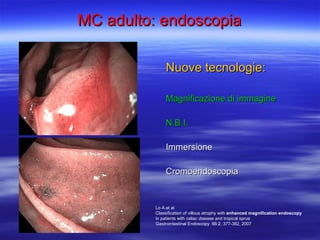 MC adulto: endoscopia Nuove tecnologie: Magnificazione di immagine N.B.I. Immersione Cromoendoscopia Lo A.et al  Classification of villous atrophy with  enhanced magnification endoscopy  in patients with celiac disease and tropical sprue  Gastrointestinal Endoscopy  66:2, 377-382, 2007 