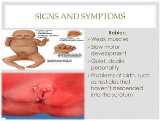 SIGNS AND SYMPTOMS
Babies:
Weak muscles
Slow motor
development
Quiet, docile
personality
Problems at birth, such
as testicles that
haven’t descended
into the scrotum
 