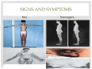 SIGNS AND SYMPTOMS
Boy Teenagers
 