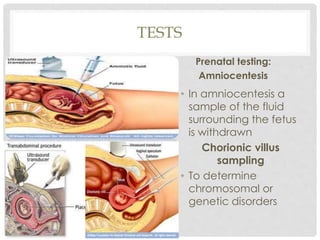 TESTS
Prenatal testing:
Amniocentesis
• In amniocentesis a
sample of the fluid
surrounding the fetus
is withdrawn
Chorionic villus
sampling
• To determine
chromosomal or
genetic disorders
 