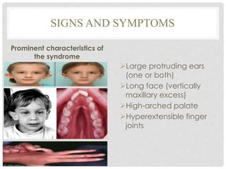 SIGNS AND SYMPTOMS
Prominent characteristics of
the syndrome
Large protruding ears
(one or both)
Long face (vertically
maxillary excess)
High-arched palate
Hyperextensible finger
joints
 