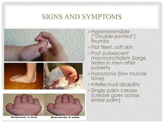 SIGNS AND SYMPTOMS
Hyperextensible
(“Double-jointed”)
thumbs
Flat fleet, soft skin
Post pubescent
macroorchidism (large
testes in men after
puberty
Hypotonia (low muscle
tone)
Intellectual disability
Single palm crease
(crease goes across
entire palm)
 