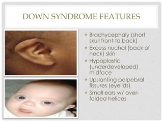 DOWN SYNDROME FEATURES
 Brachycephaly (short
skull front-to back)
 Excess nuchal (back of
neck) skin
 Hypoplastic
(underdeveloped)
midface
 Upslanting palpebral
fissures (eyelids)
 Small ears w/ over-
folded helices
 