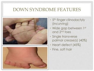 DOWN SYNDROME FEATURES
• 5th finger clinodactyly
(incurving)
• Wide gap between 1st
and 2nd toes
• Single transverse
palmar crease(s) (40%)
• Heart defect (45%)
• Fine, soft hair
 