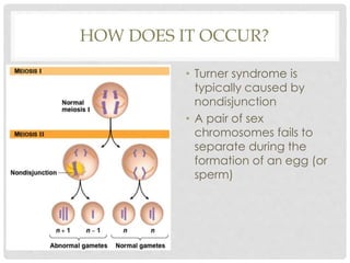 HOW DOES IT OCCUR?
• Turner syndrome is
typically caused by
nondisjunction
• A pair of sex
chromosomes fails to
separate during the
formation of an egg (or
sperm)
 