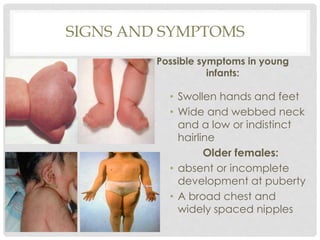 SIGNS AND SYMPTOMS
Possible symptoms in young
infants:
• Swollen hands and feet
• Wide and webbed neck
and a low or indistinct
hairline
Older females:
• absent or incomplete
development at puberty
• A broad chest and
widely spaced nipples
 