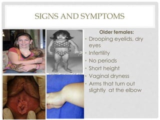 SIGNS AND SYMPTOMS
Older females:
• Drooping eyelids, dry
eyes
• Infertility
• No periods
• Short height
• Vaginal dryness
• Arms that turn out
slightly at the elbow
 