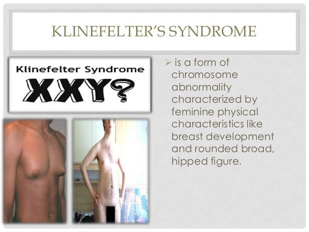 Pervasive developmental disorders (turner syndrome, klinefelter's syn…