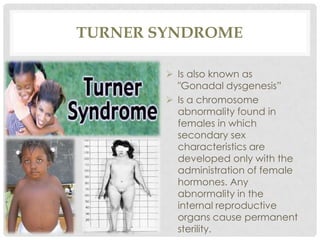 TURNER SYNDROME
 Is also known as
"Gonadal dysgenesis”
 Is a chromosome
abnormality found in
females in which
secondary sex
characteristics are
developed only with the
administration of female
hormones. Any
abnormality in the
internal reproductive
organs cause permanent
sterility.
 