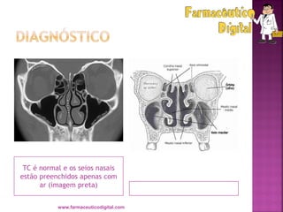 TC é normal e os seios nasais
estão preenchidos apenas com
ar (imagem preta)
www.farmaceuticodigital.com
 