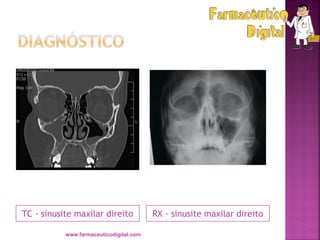 TC - sinusite maxilar direito RX - sinusite maxilar direito
www.farmaceuticodigital.com
 