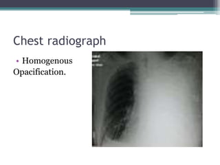 Pleural Effusion Lecture Note by Gboneme Sandra | PPTX