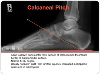 A line is drawn from planter most surface of calcaneum to the inferior
border of distal articular surface.
Normal 17-32 degree
Usually normal in CMT with forefoot equinus, increased in idiopathic
cases and in poliomyelitis
 
