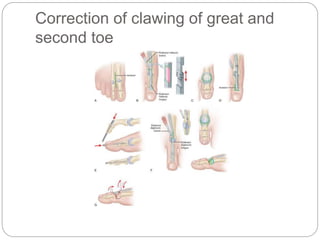 Correction of clawing of great and
second toe
 