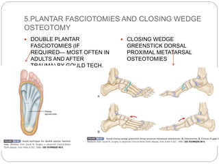 5.PLANTAR FASCIOTOMIES AND CLOSING WEDGE
OSTEOTOMY
 DOUBLE PLANTAR
FASCIOTOMIES (IF
REQUIRED— MOST OFTEN IN
ADULTS AND AFTER
TRAUMA) BY GOULD TECH.
 CLOSING WEDGE
GREENSTICK DORSAL
PROXIMAL METATARSAL
OSTEOTOMIES
 