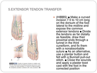 5.EXTENSOR TENDON TRANSFER
 (HIBBS) ■ Make a curved
incision 7.5 to 10 cm long
on the dorsum of the foot
lateral to the midline and
expose the common
extensor tendons ■ Divide
the tendons as far distally
as feasible, draw their
proximal ends through a
tunnel in the third
cuneiform, and fix them
with a nonabsorbable
suture ■ As an alternative,
use a plantar button and
felt with a Bunnell pull-out
stitch. ■ Close the wounds
and apply a plaster boot
cast with the foot in the
corrected position
 