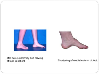 Mild cavus deformity and clawing
of toes in patient Shortening of medial column of foot.
 