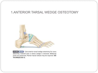1.ANTERIOR TARSAL WEDGE OSTEOTOMY
 