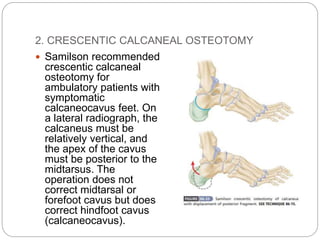 2. CRESCENTIC CALCANEAL OSTEOTOMY
 Samilson recommended
crescentic calcaneal
osteotomy for
ambulatory patients with
symptomatic
calcaneocavus feet. On
a lateral radiograph, the
calcaneus must be
relatively vertical, and
the apex of the cavus
must be posterior to the
midtarsus. The
operation does not
correct midtarsal or
forefoot cavus but does
correct hindfoot cavus
(calcaneocavus).
 