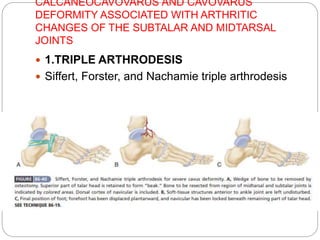 CALCANEOCAVOVARUS AND CAVOVARUS
DEFORMITY ASSOCIATED WITH ARTHRITIC
CHANGES OF THE SUBTALAR AND MIDTARSAL
JOINTS
 1.TRIPLE ARTHRODESIS
 Siffert, Forster, and Nachamie triple arthrodesis
 