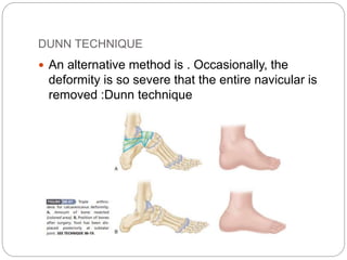DUNN TECHNIQUE
 An alternative method is . Occasionally, the
deformity is so severe that the entire navicular is
removed :Dunn technique
 