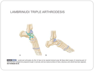 LAMBRINUDI TRIPLE ARTHRODESIS
 