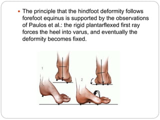  The principle that the hindfoot deformity follows
forefoot equinus is supported by the observations
of Paulos et al.: the rigid plantarflexed first ray
forces the heel into varus, and eventually the
deformity becomes fixed.
 