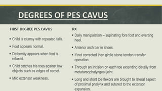 DEGREES OF PES CAVUS
FIRST DEGREE PES CAVUS
 Child is clumsy with repeated falls.
 Foot appears normal.
 Deformity appears when foot is
relaxed.
 Child catches his toes against low
objects such as edges of carpet.
 Mild extensor weakness.
RX
 Daily manipulation – supinating fore foot and everting
heel.
 Anterior arch bar in shoes.
 If not corrected then girdle stone tendon transfer
operation.
 Through an incision on each toe extending distally from
metatarsophalyngeal joint.
 Long and short toe flexors are brought to lateral aspect
of proximal phalynx and sutured to the extensor
expansion.
 